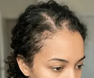 Before — Scalp microneedling — part-line density improvement